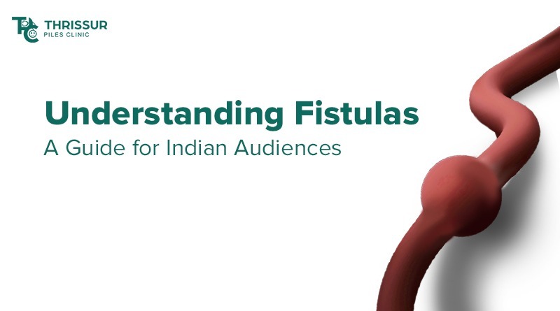 Understanding Fistulas
